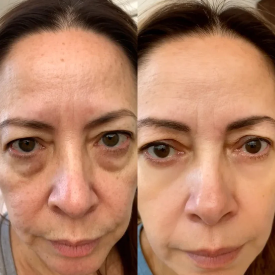 Before and after comparison showing reduced under-eye puffiness and dark circles.
