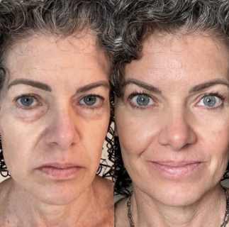 Before and after results using red light therapy eye mask for puffiness and dark circles