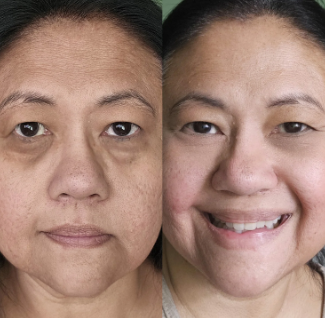 Before and after results using red light therapy eye mask for puffiness and dark circles.